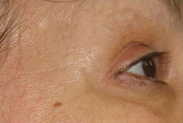 Results of Vita Cura on the eye area; Before and After