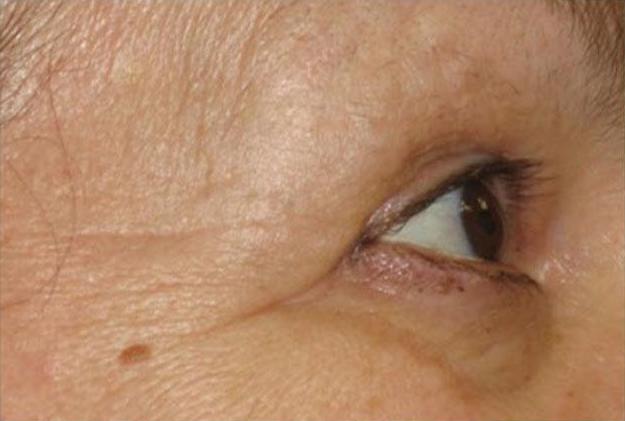 Results of Vita Cura on the eye area; Before and After