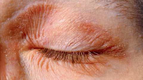 Dry and Red Eyelid