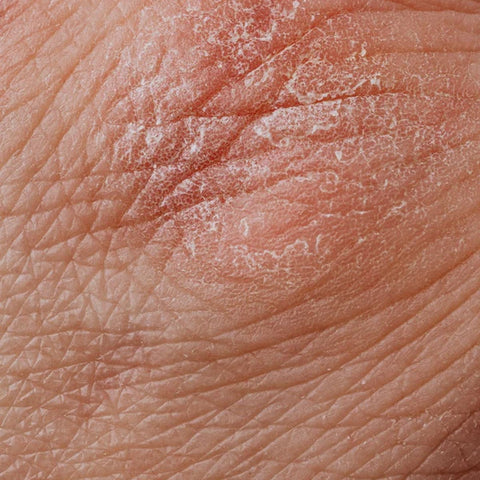 What Causes Dry Skin?