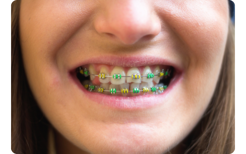 Close-up of a girl with yellow and green colored braces