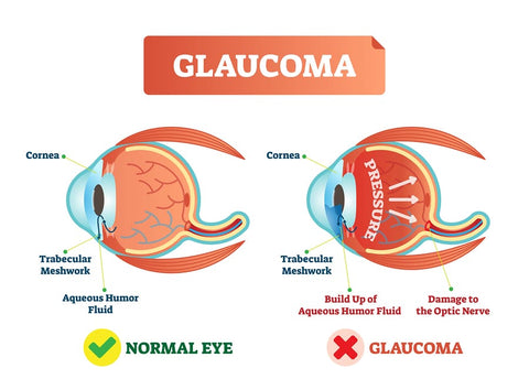 Glaucoma testing at iSeeU Optometry Clinic