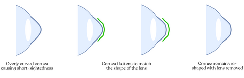 Ortho-K lense at IseeU optometry clinic in Palm. Desert