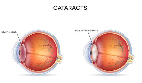 IseeU Optometrist Clinic Cataract Diagnosis