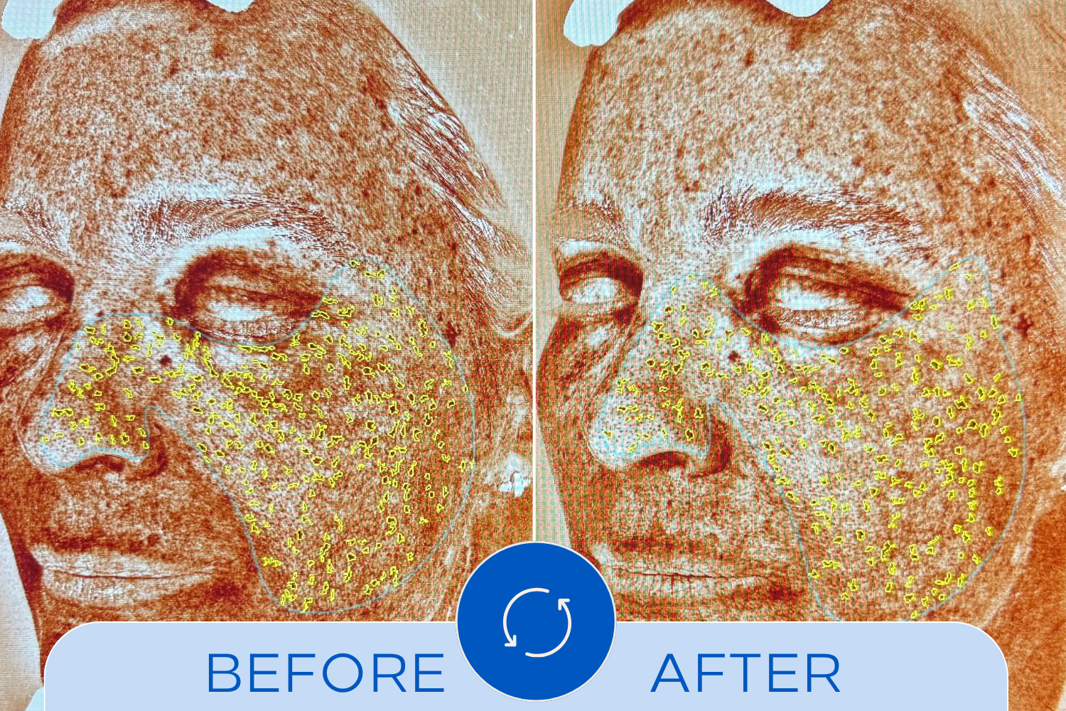 Reducción de manchas marrones - antes y después