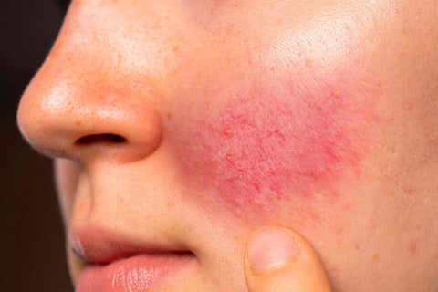 Bdr mit rosacea