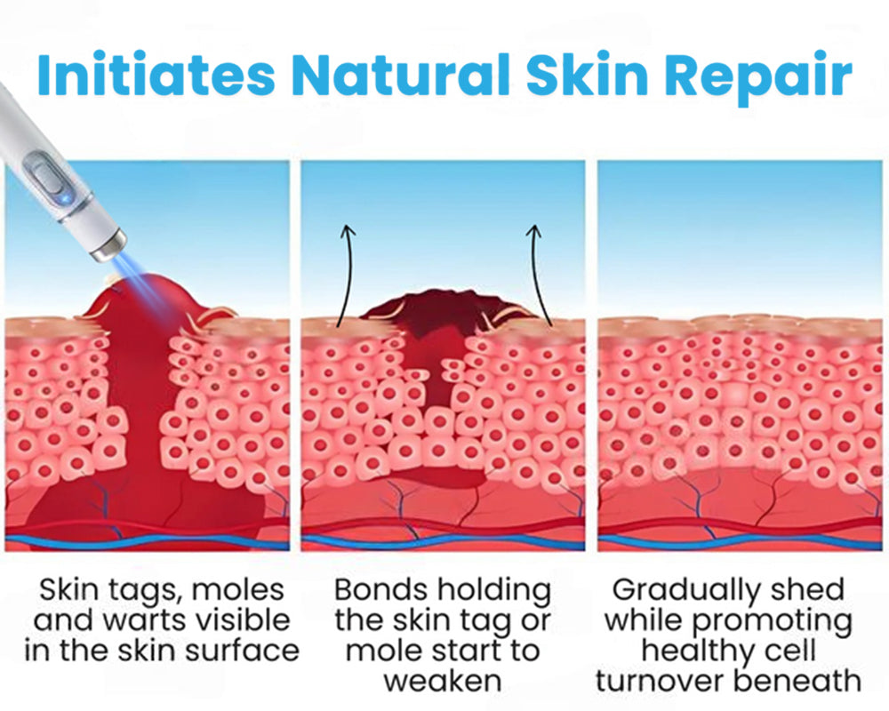 Seurico™ Laser Pen - Non-invasive Mole and Wart Removal