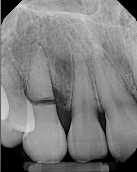 Radiography of a broken canine