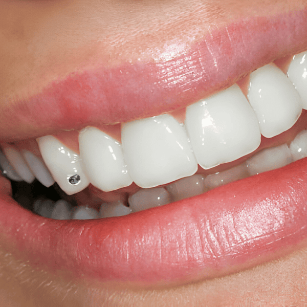 strass dentaire