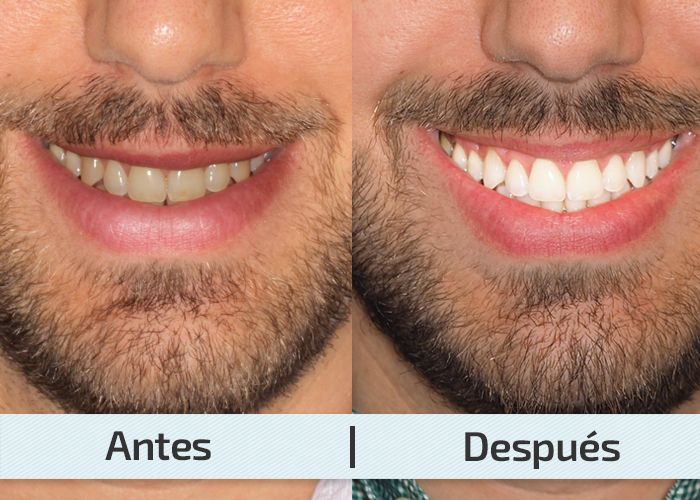 Blanqueamiento dental - Imagen 6