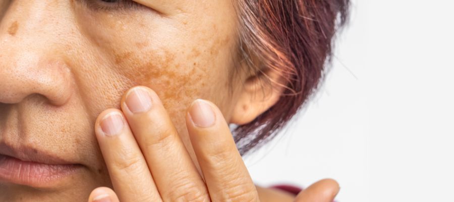 Asian woman with age spots or melasma due to sun radiation