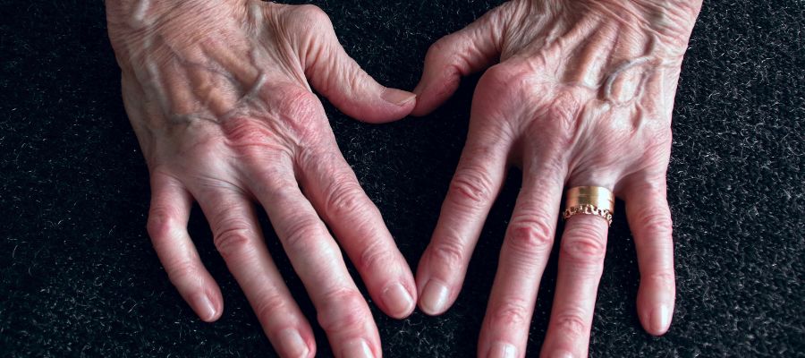 Rheumatoid Nodules in Fingers