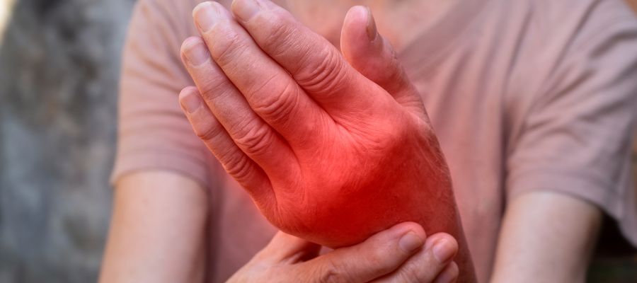 Rheumatoid Nodules in Hand red and inflamed