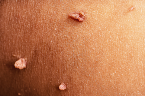 skin tags on body