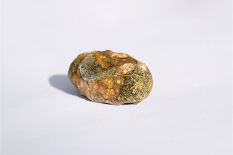 Gallstone from gallbladder