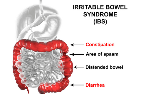 Diagram of irritable bowel syndrome with its symptoms written