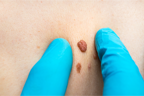 Person with blue gloves squeezing skin tag on back