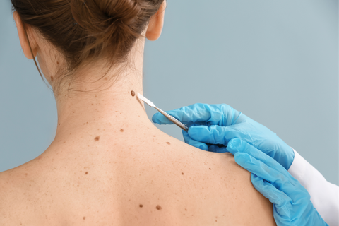 Woman with skin tag being inspected by doctor