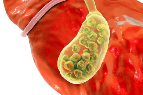 Gallstones in gallbladder