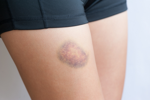 Person with bruise on leg wearing black biker shorts