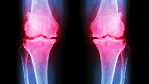 X-ray showing joint pain in knees from osteoarthritis