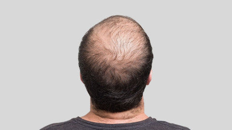 premature balding male with hyperthyroidism