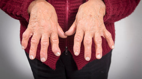 Rheumatoid arthritis in fingers vs osteoarthritis