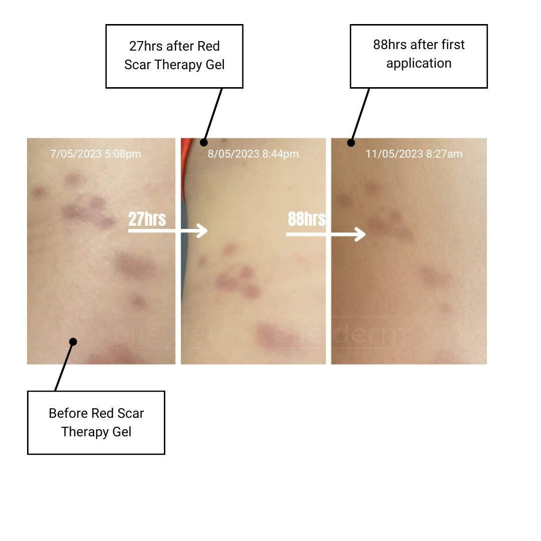 red acne scars