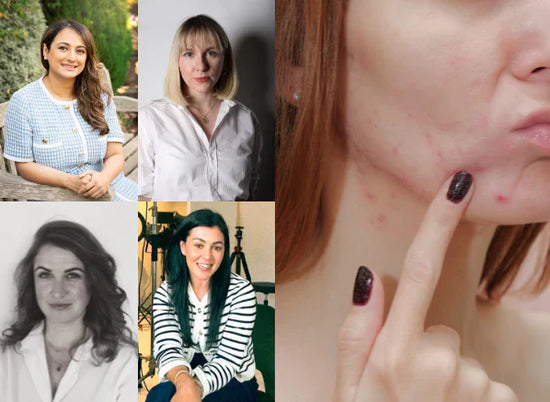 Understanding Acne and The Expert Tips You Need To Control It