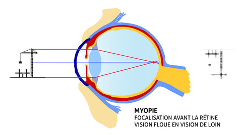 myopic eye