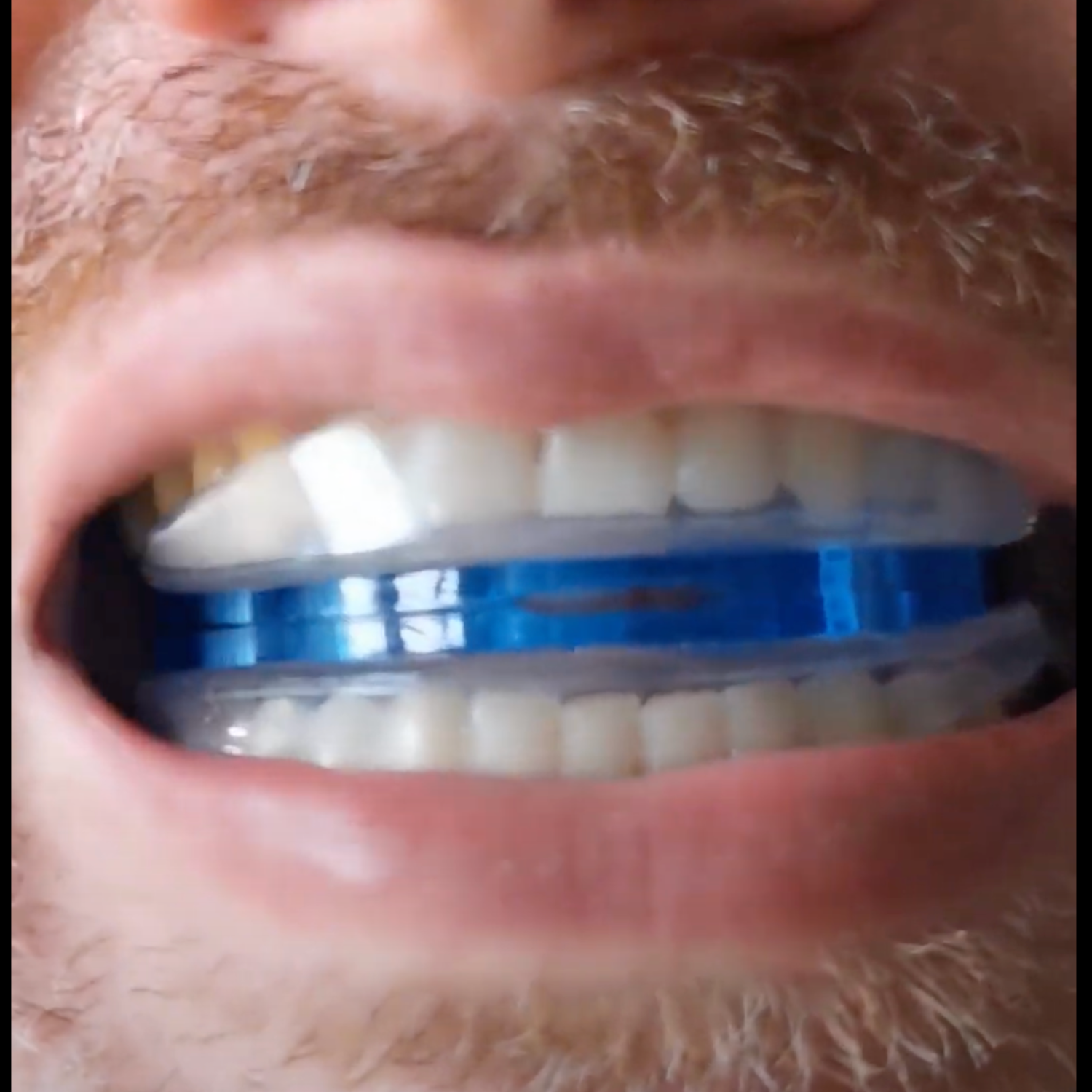 Close-up of a person wearing a blue and clear mouthguard.