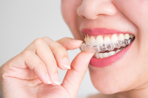 Invisalign vs Mail Order Braces