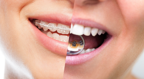 Lingual braces vs Ceramic braces