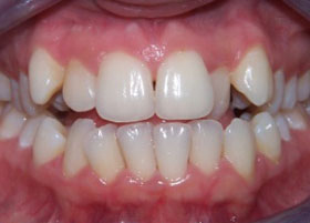Ceramic Braces Case Study | Oldham | Manchester Orthodontics 