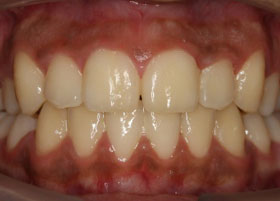 Ceramic Braces Case Study | Oldham | Manchester Orthodontics 