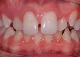 Ceramic Braces Case Study | Oldham | Manchester Orthodontics 