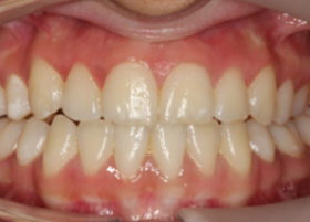 Ceramic Braces Case Study | Oldham | Manchester Orthodontics 