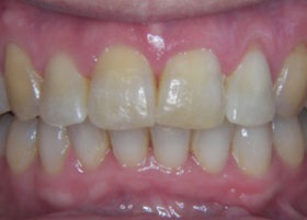 Ceramic Braces Case Study | Oldham | Manchester Orthodontics 