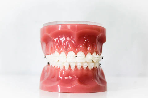 ceramic braces