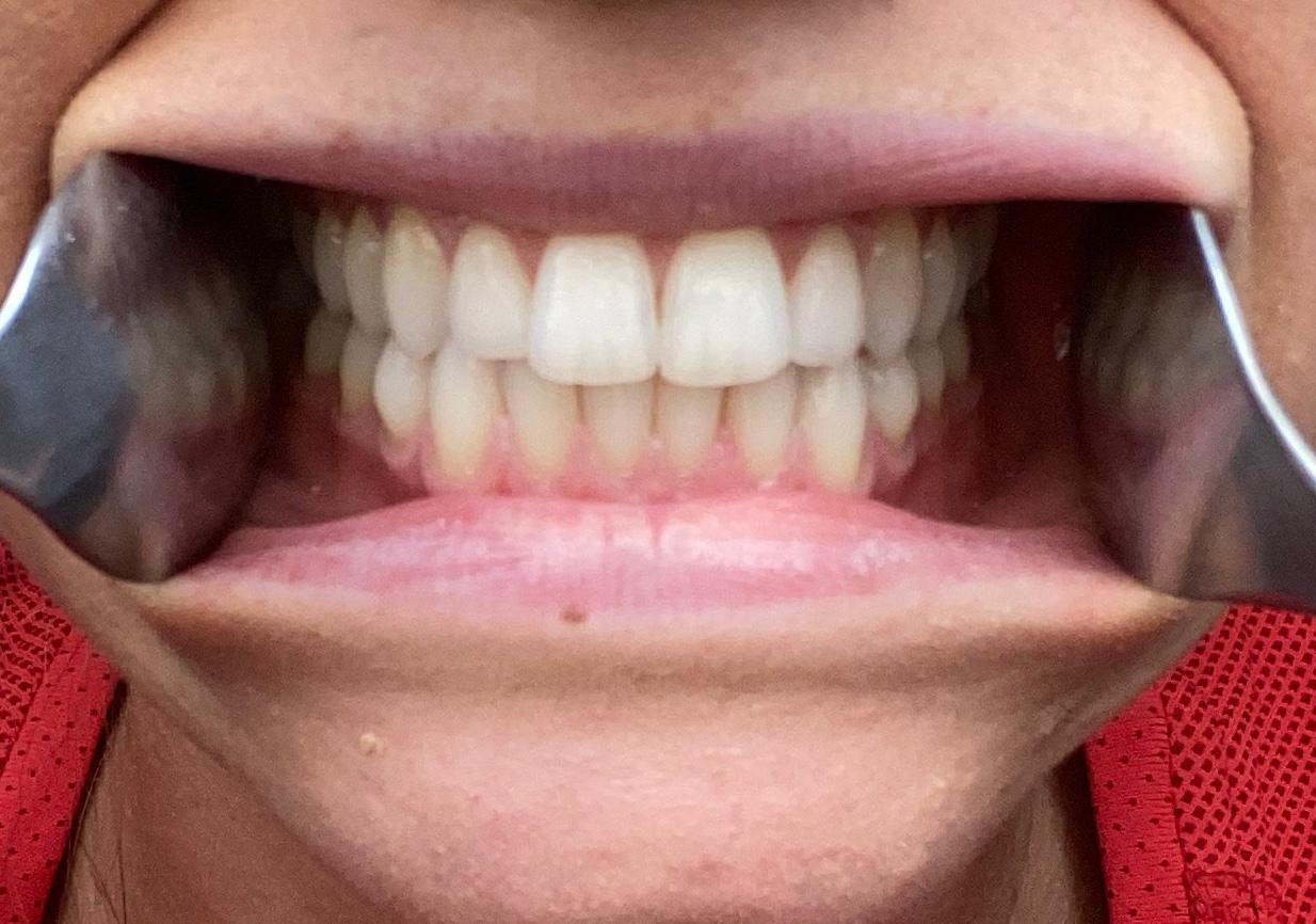 Adult Braces Remote Consultation | Teeth Straightening | Oldham | Manchester Orthodontics