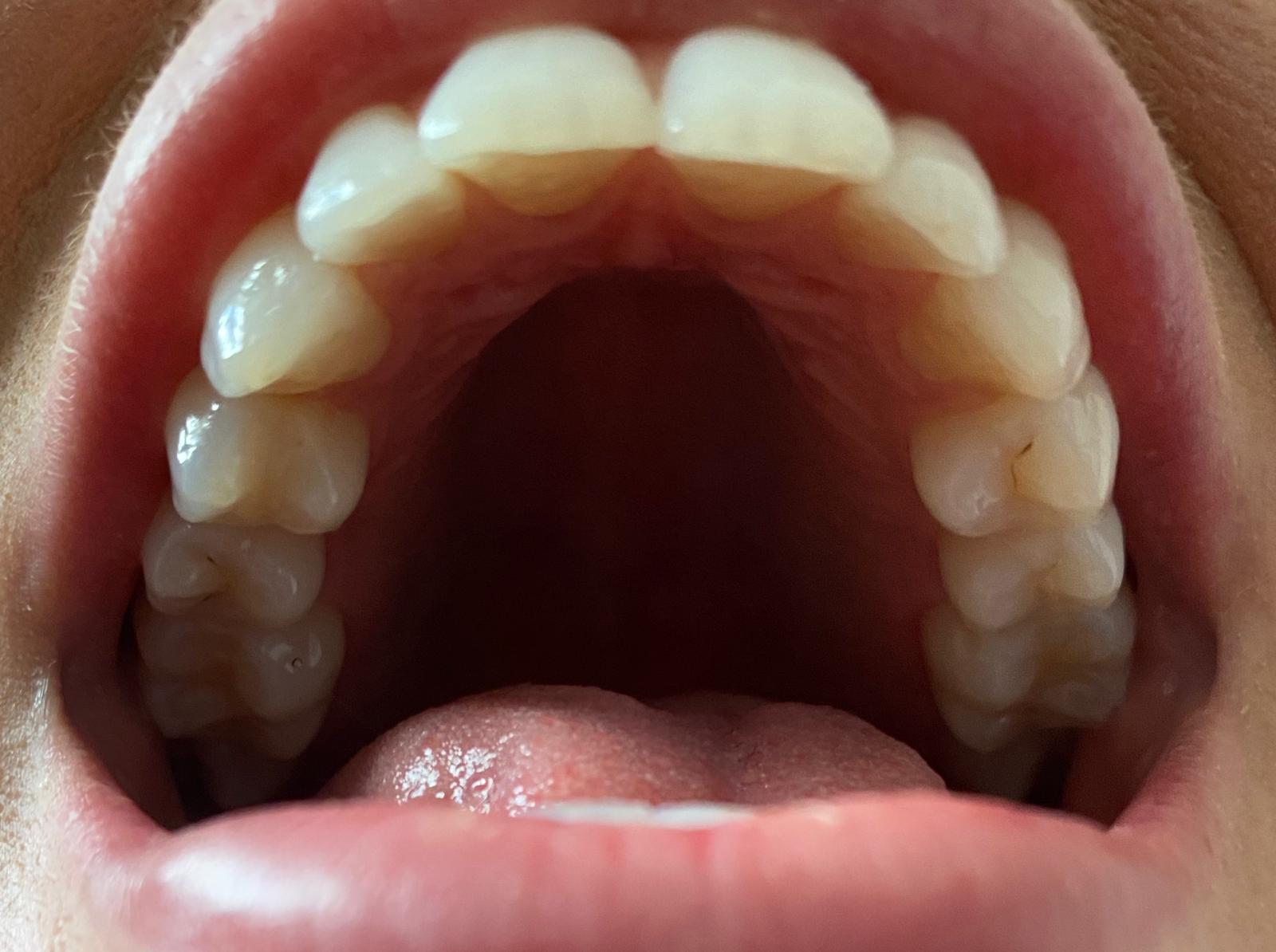 Teeth Straightening Remote Consultation | Oldham | Manchester Orthodontics