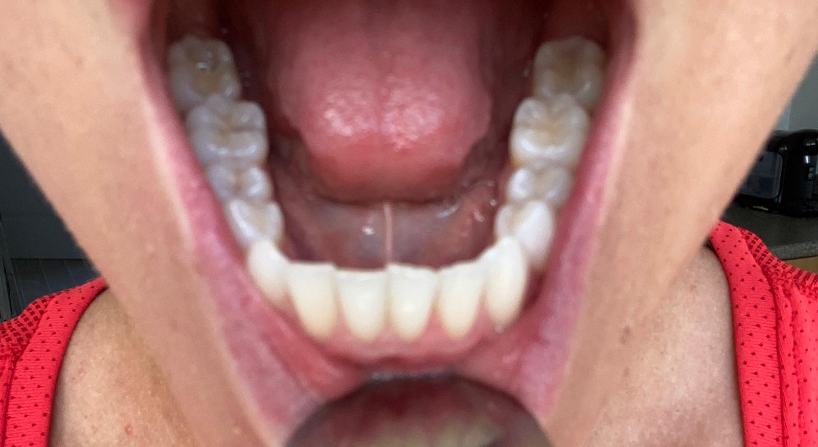 Teeth Straightening Remote Consultation | Oldham | Manchester Orthodontics