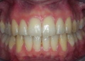 Invisalign Braces | Oldham | Manchester Orthodontics