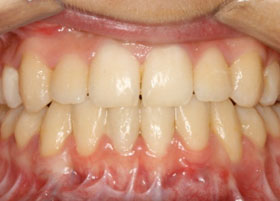 Jaw Surgery | Oldham | Manchester Orthodontics