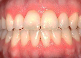 Jaw Surgery | Oldham | Manchester Orthodontics