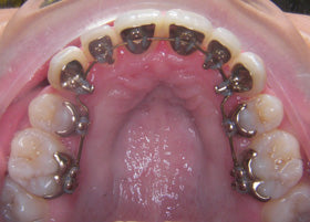 Lingual Braces Case Studies | Oldham | Manchester Orthodontics