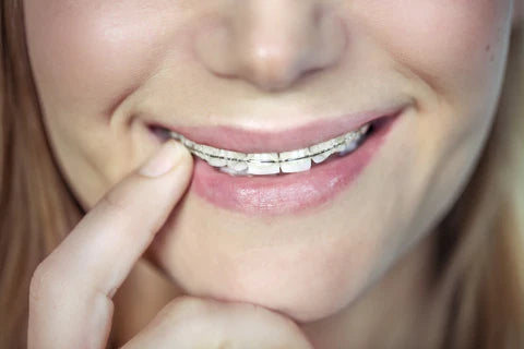 adult braces