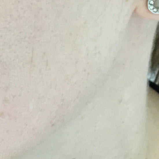 Fivfivgo® Stift zum Entfernen von Hautflecken und Leberflecken