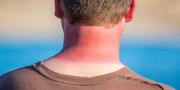 Apply sunscreen on you ears and back of your neck. Every day.