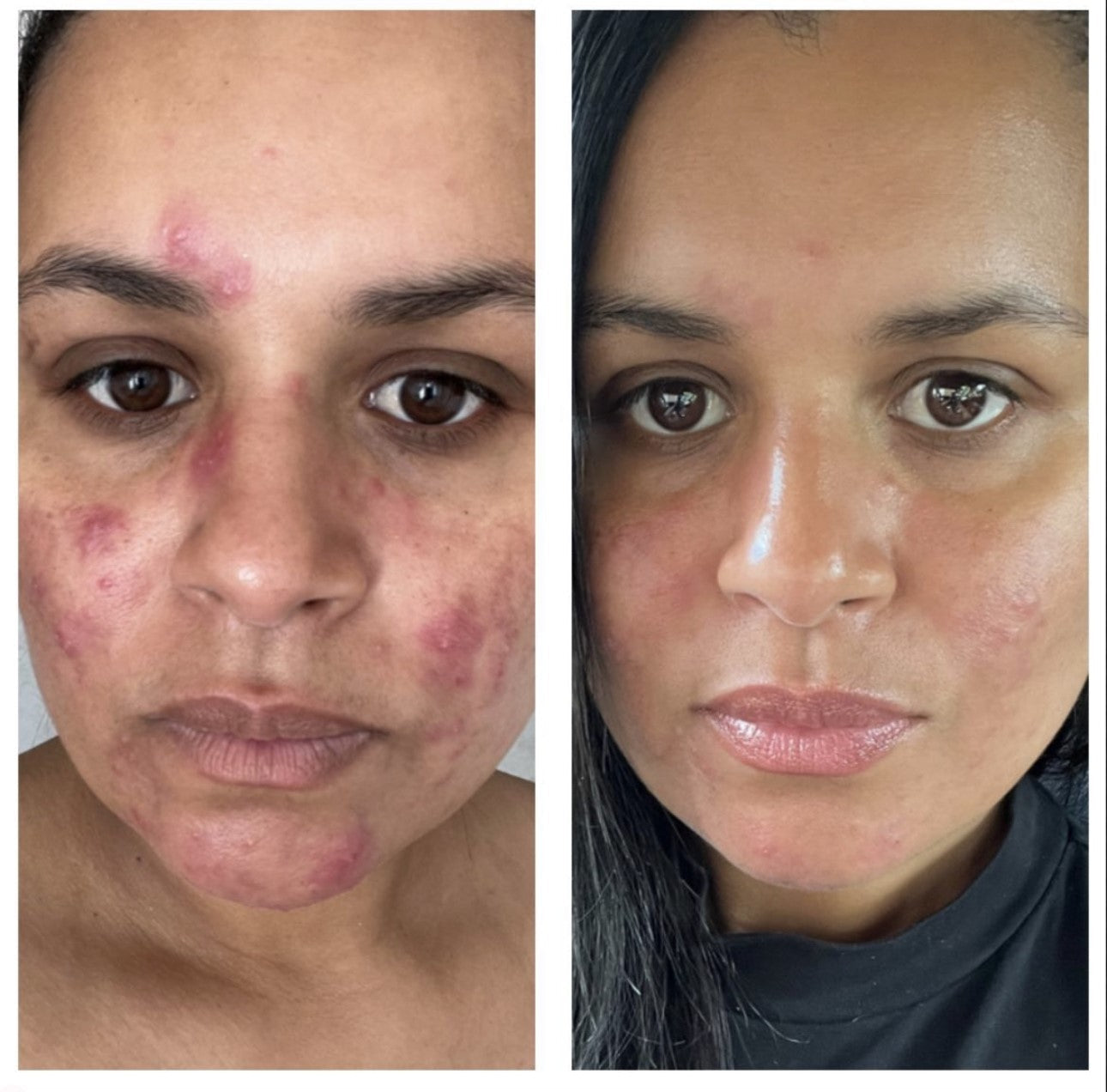 Side-by-side before and after images showing skin improvement from acne treatment.